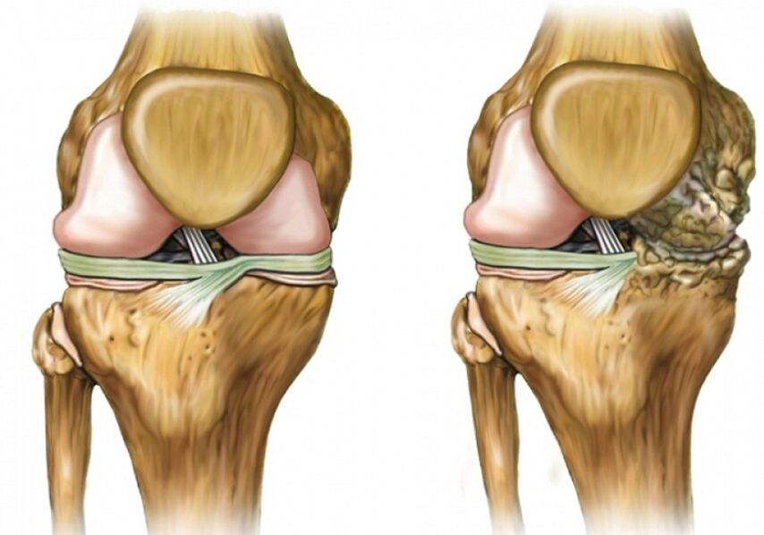 Arthrosis deformálása